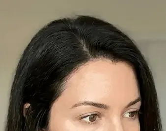 After — Scalp microneedling — crown density improvement
